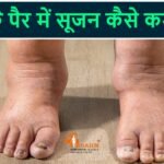 पैर के पंजे में सूजन कम करने के लिए,  नसों में ब्लॉकेज के कारण खून सर्कुलेशन रुका है तो –
